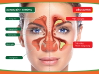 Biến chứng của bệnh viêm xoang